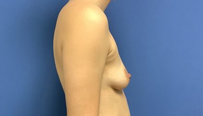 Breast Augmentation Before & After Patient #503