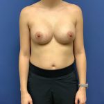 Breast Augmentation Before & After Patient #508