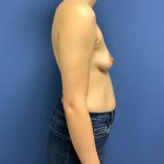 Breast Augmentation Before & After Patient #508