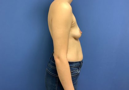 Breast Augmentation Before & After Patient #508