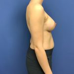 Breast Augmentation Before & After Patient #508