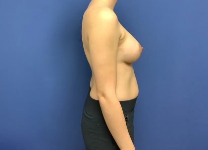 Breast Augmentation Before & After Patient #508