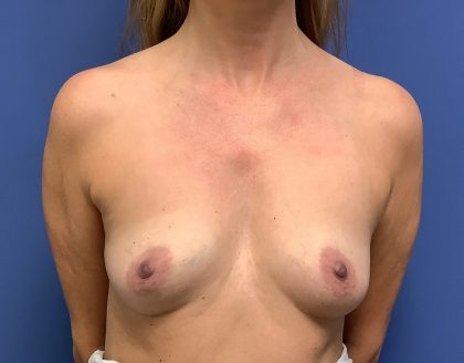 Breast Augmentation Before & After Patient #513