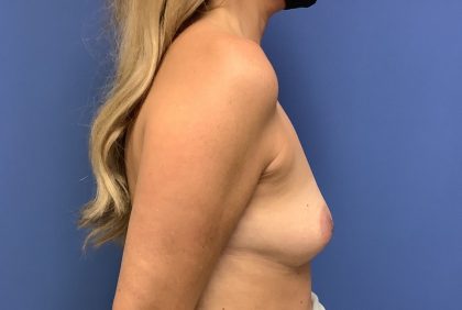 Breast Augmentation Before & After Patient #513
