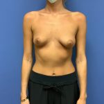 Breast Augmentation Before & After Patient #518