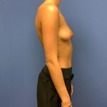 Breast Augmentation Before & After Patient #518