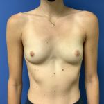 Breast Augmentation Before & After Patient #523