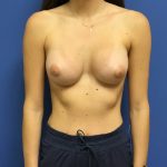 Breast Augmentation Before & After Patient #523