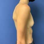 Breast Augmentation Before & After Patient #523