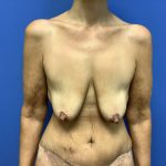 Breast Augmentation Before & After Patient #533