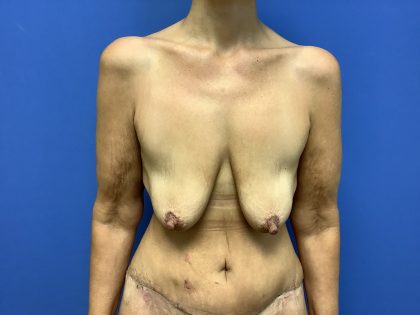 Breast Augmentation Before & After Patient #533