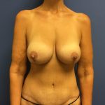 Breast Augmentation Before & After Patient #533