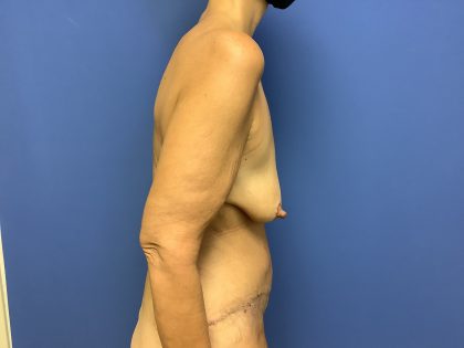 Breast Augmentation Before & After Patient #533