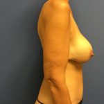 Breast Augmentation Before & After Patient #533