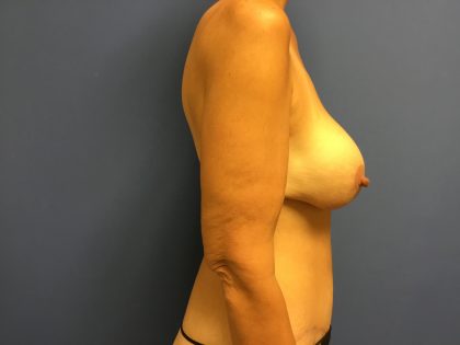 Breast Augmentation Before & After Patient #533