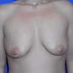 Breast Augmentation Before & After Patient #538
