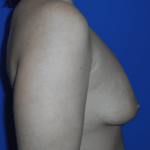 Breast Augmentation Before & After Patient #538