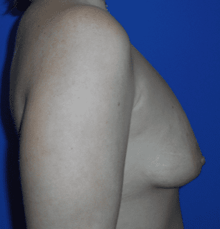 Breast Augmentation Before & After Patient #538
