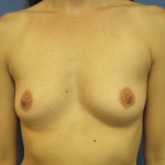 Breast Augmentation Before & After Patient #543
