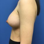 Breast Augmentation Before & After Patient #548