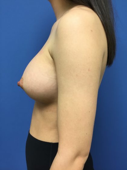 Breast Augmentation Before & After Patient #548