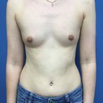 Breast Augmentation Before & After Patient #558
