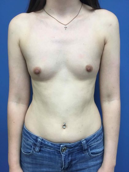 Breast Augmentation Before & After Patient #558