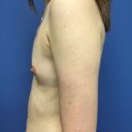 Breast Augmentation Before & After Patient #558