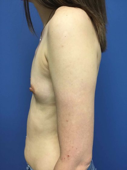 Breast Augmentation Before & After Patient #558