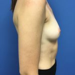 Breast Augmentation Before & After Patient #563
