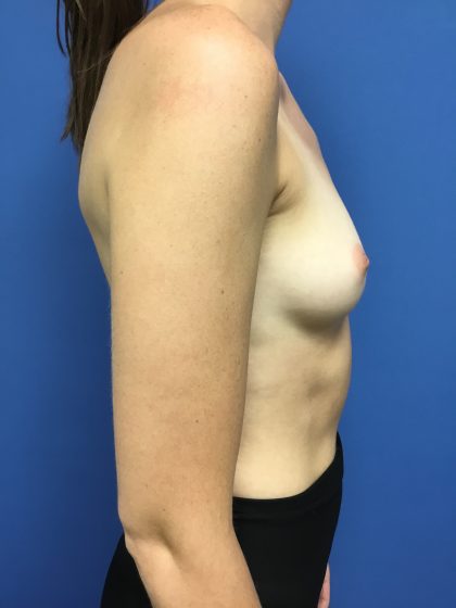 Breast Augmentation Before & After Patient #563