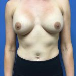Breast Augmentation Before & After Patient #568