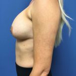 Breast Augmentation Before & After Patient #568