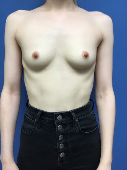 Breast Augmentation Before & After Patient #573