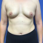 Breast Augmentation Before & After Patient #578