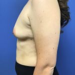 Breast Augmentation Before & After Patient #578