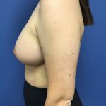 Breast Augmentation Before & After Patient #578