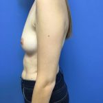 Breast Augmentation Before & After Patient #583