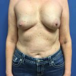Breast Augmentation Before & After Patient #588