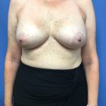 Breast Augmentation Before & After Patient #588