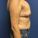 Breast Augmentation Before & After Patient #588