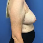 Breast Augmentation Before & After Patient #588