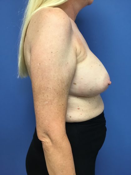 Breast Augmentation Before & After Patient #588
