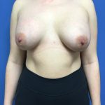 Breast Augmentation Before & After Patient #593