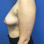 Breast Augmentation Before & After Patient #593