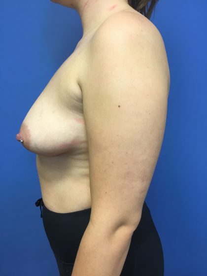 Breast Augmentation Before & After Patient #593