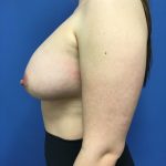 Breast Augmentation Before & After Patient #593