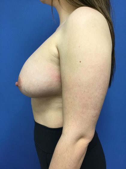 Breast Augmentation Before & After Patient #593