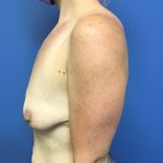 Breast Augmentation Before & After Patient #598