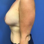 Breast Augmentation Before & After Patient #598
